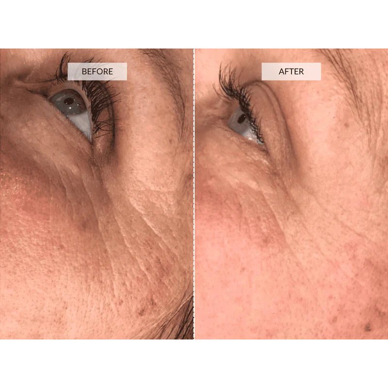 Before and After Photo: Dermalux Flex MD